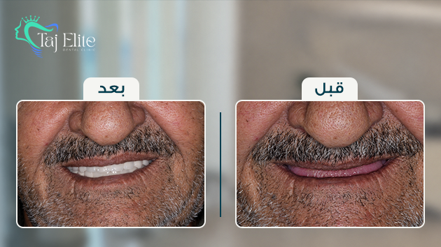before-^-after